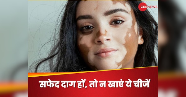 Vitiligo: सफेद दाग से हैं परेशान, तो न खाएं ये चीजें, बढ़ सकते हैं व्हाइट पैचेज