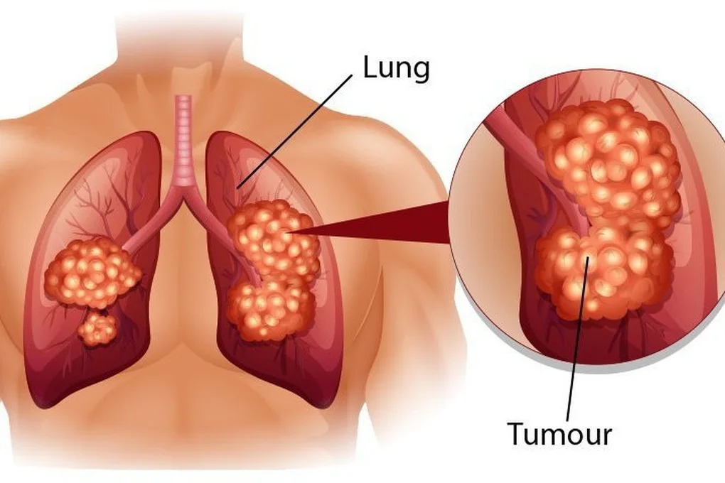 Phát hiện ở giai đoạn sớm, ung thư phổi vẫn có thể quay trở lại - 2