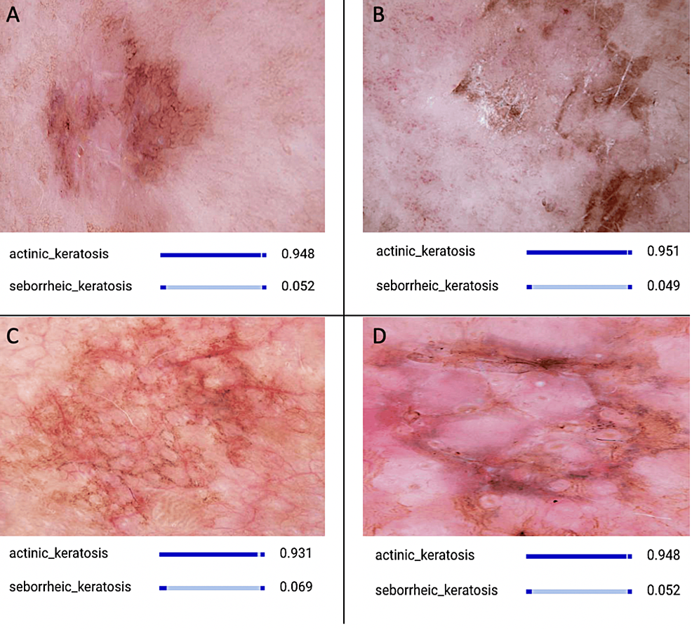 Artificial Intelligence-Based Distinction of Actinic Keratosis and Seborrheic Keratosis