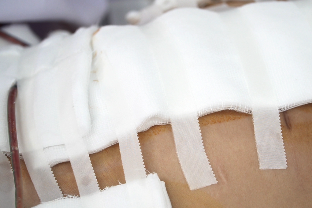 Vụ tai biến sau hút mỡ ở TPHCM: Nạn nhân “tha thiết” mổ dù có bệnh nền?
