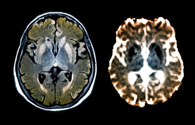 Composite image of FLAIR and diffusion MRI scans of the brain of a 47-old patient, showing hyperintensities around the area of the cortex and basal ganglia, suggestive of