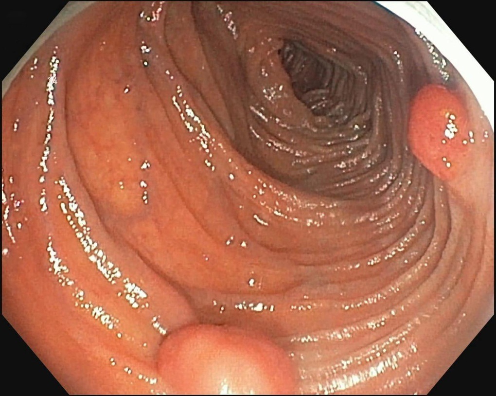 Bệnh viện Đa khoa MEDLATEC điều trị thành công bệnh đa polyp di truyền 3 thế hệ