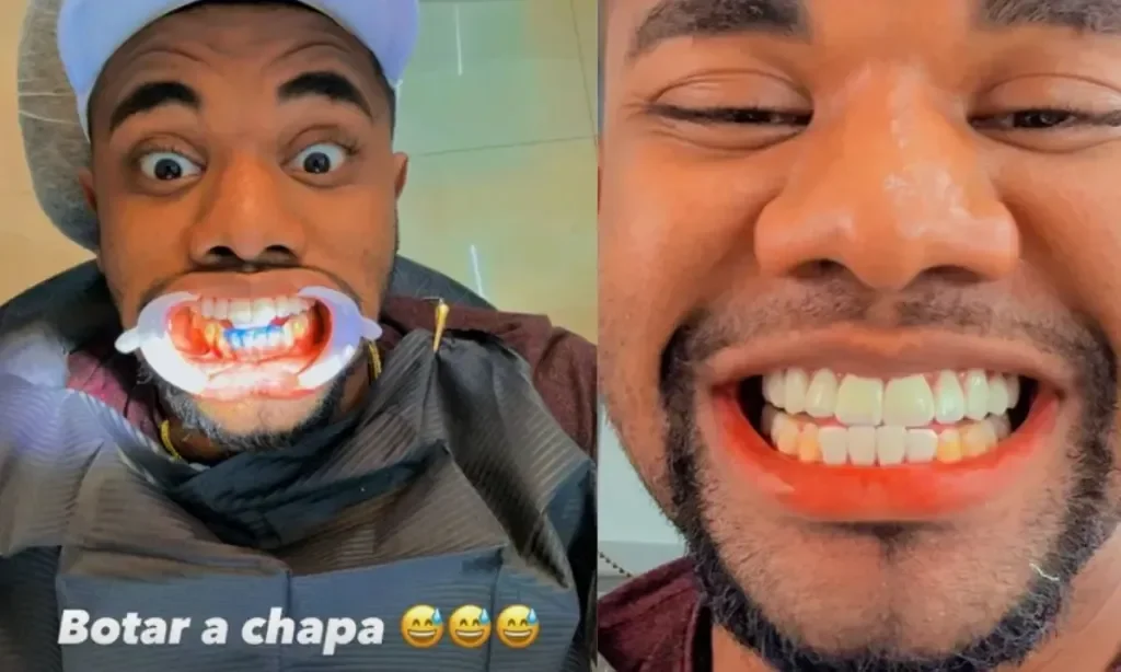 Davi mostrando o procedimento que fez nos dentes – Foto: Reprodução/Instagram de Davi Brito