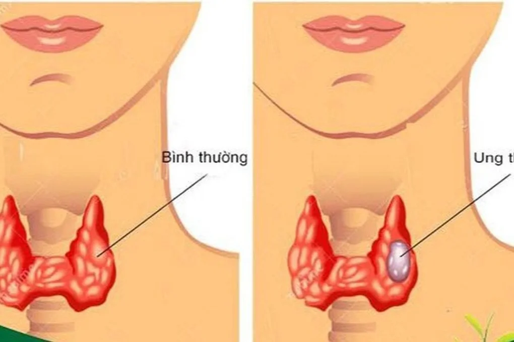 Bệnh ung thư nghệ sĩ Hoài Linh mắc phải có nguy hiểm? - 2