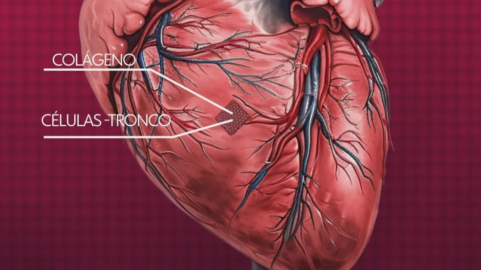 Curativo para corações infartados: conheça tecnologia — Foto: Reprodução/TV Globo