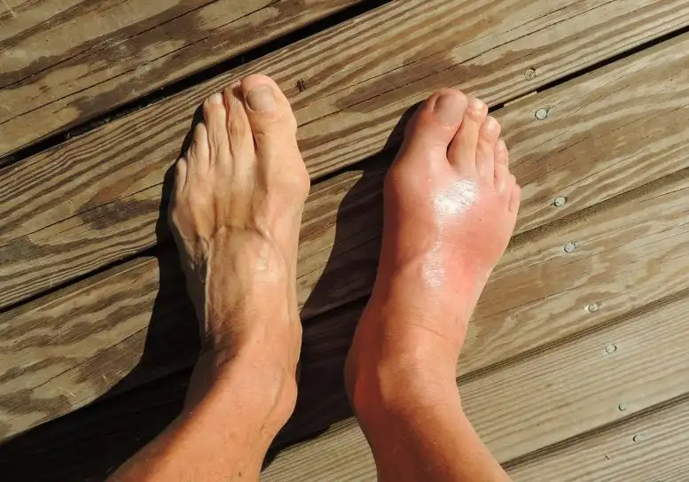 Gout Swollen Feet