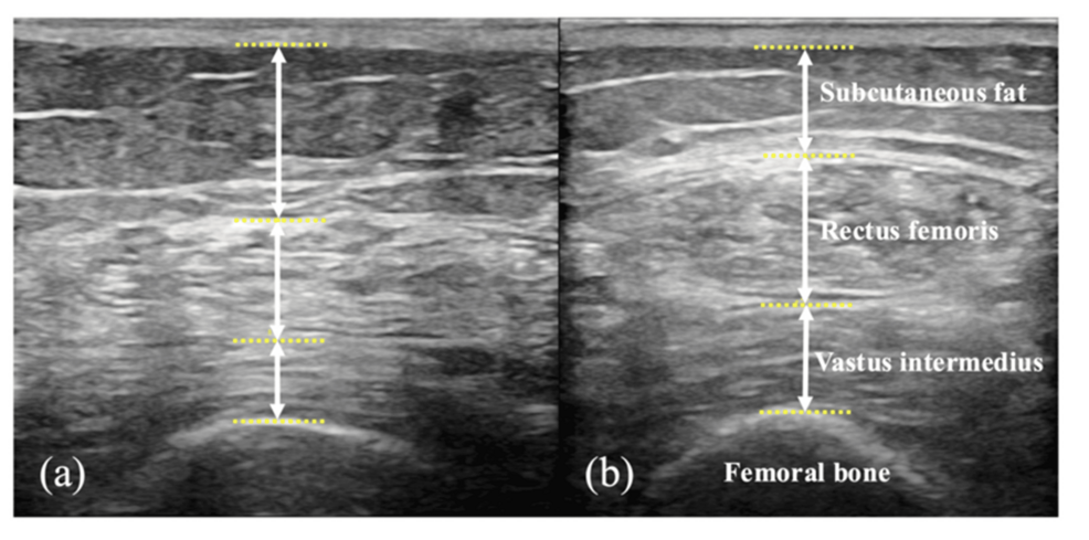 Combined Exercise and Nutritional Therapy Improves Physical Functions and Activities of Daily Living in Patients With Multimorbidity Undergoing Convalescent Rehabilitation: A Case Report