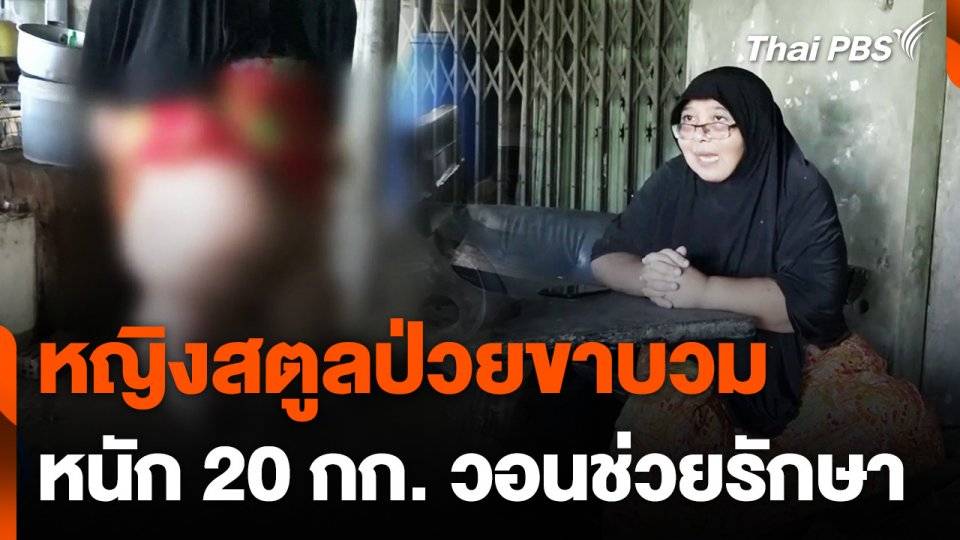 หญิงสตูลป่วยขาบวมหนัก 20 กก. วอนช่วยรักษา | Thai PBS