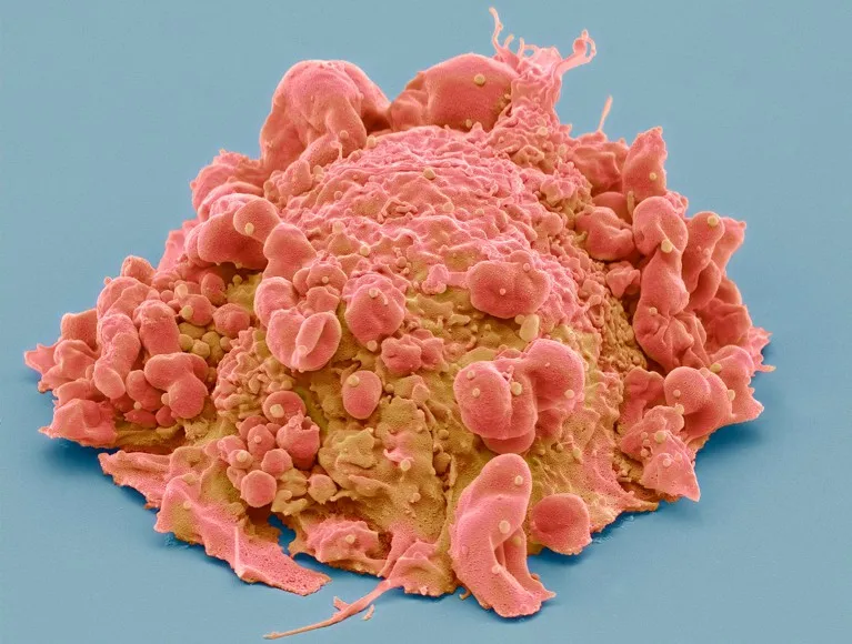 Coloured scanning electron micrograph of a cancer cell from the human colon.