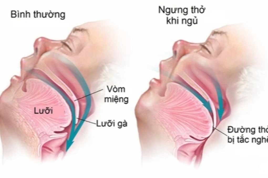 Ngủ ngáy, buồn ngủ ban ngày cảnh báo hội chứng ngưng thở nguy hiểm