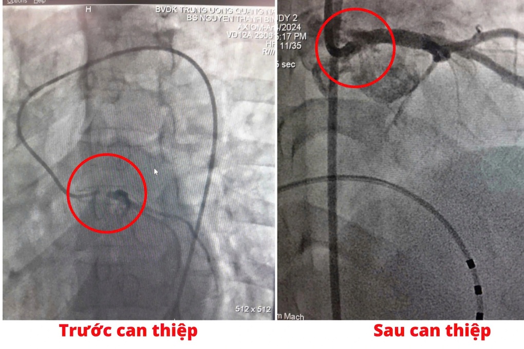 Cứu sống nữ bệnh nhân nhồi máu cơ tim cấp