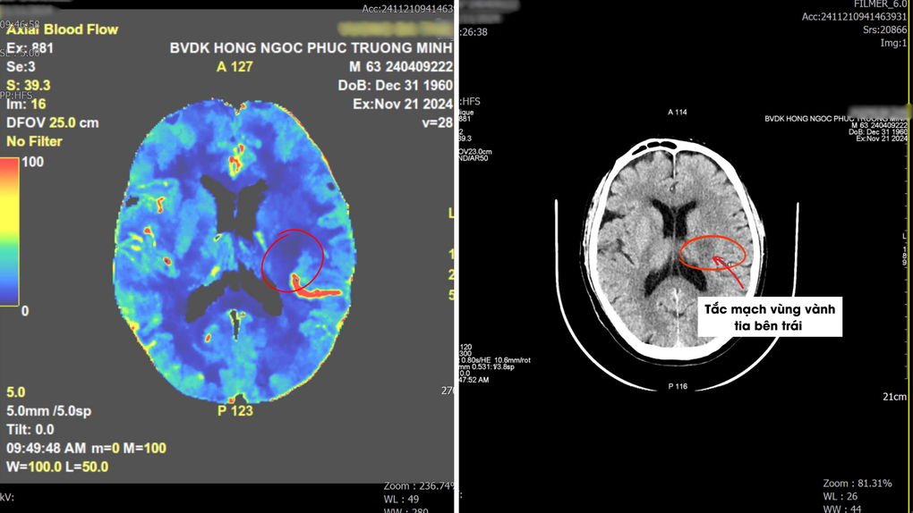 Phát hiện đột quỵ sớm nhờ chụp CT 2.560 lát cắt, bệnh nhân thoát liệt người