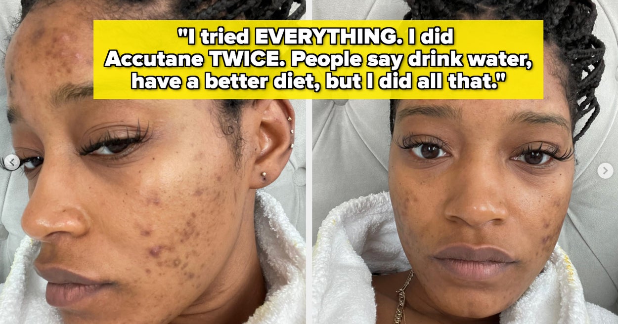 11 Famous People Who Have Been Candid About Struggling With Acne, And It’s So Refreshing To Hear