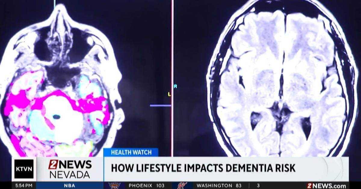 Health Watch: Lifestyle impact on dementia risk