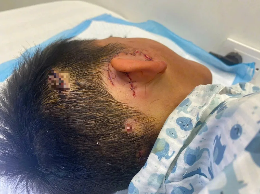 Hà Nội: Bé trai bị chó nhà cắt gần đứt rời vành tai - 2 Hà Nội: Bé trai bị chó nhà cắt gần đứt rời vành tai - 2
