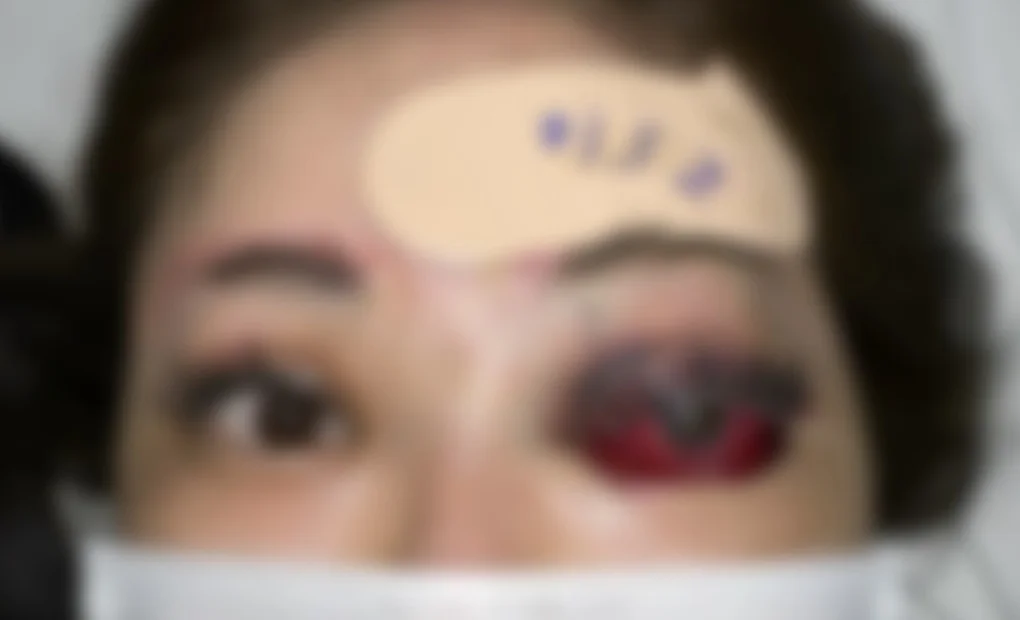 Nữ sinh 14 tuổi suýt mù; cô gái mắt lồi, mù vĩnh viễn vì tiêm filler - 2 Nữ sinh 14 tuổi suýt mù; cô gái mắt lồi, mù vĩnh viễn vì tiêm filler - 2
