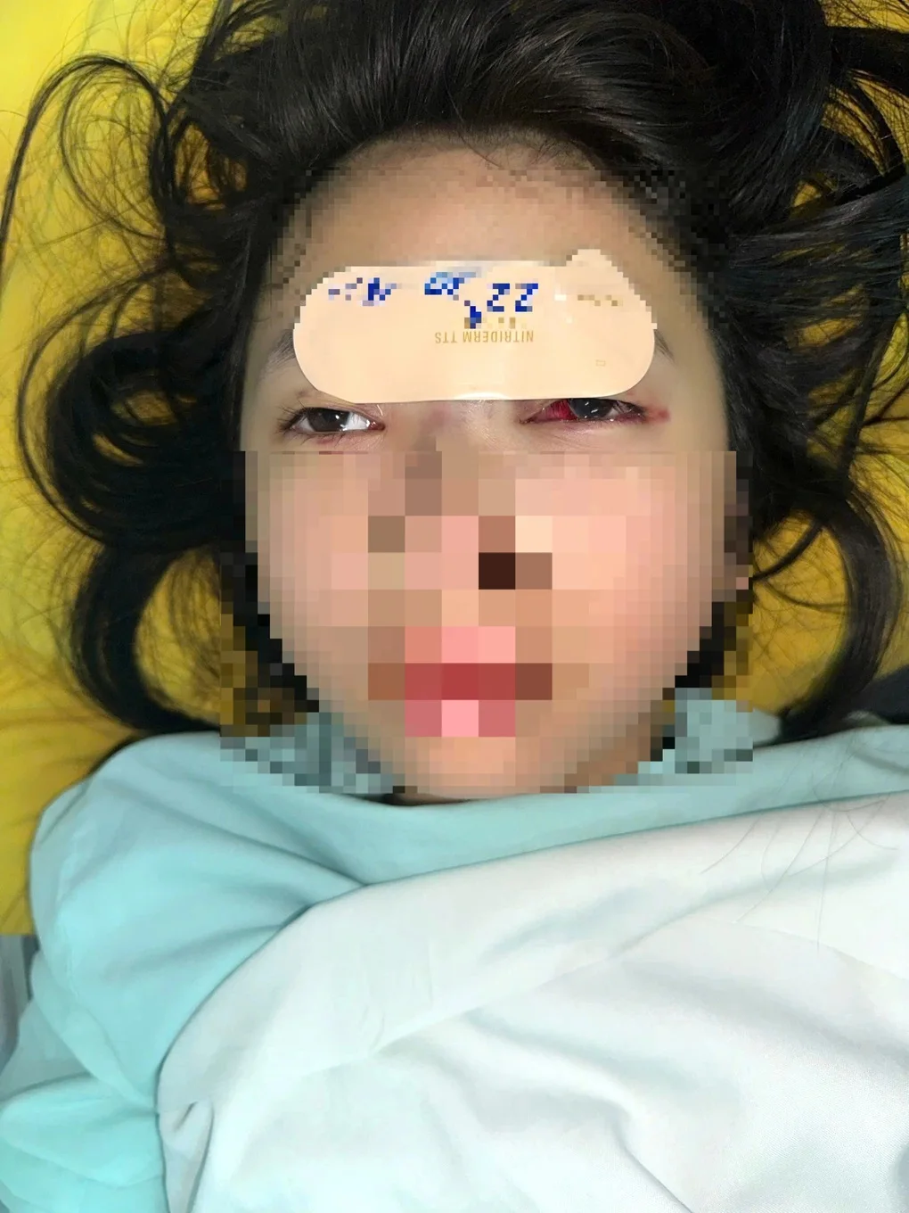 Nữ sinh 14 tuổi suýt mù; cô gái mắt lồi, mù vĩnh viễn vì tiêm filler - 3 Nữ sinh 14 tuổi suýt mù; cô gái mắt lồi, mù vĩnh viễn vì tiêm filler - 3