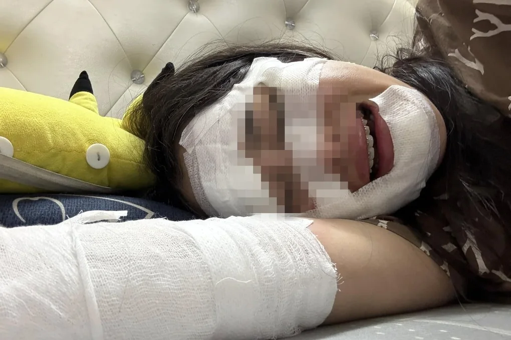 Cô gái bốc cháy, bỏng nặng ở tiệc sinh nhật: Tiết lộ hiểm họa về bóng bay - 2 Cô gái bốc cháy, bỏng nặng ở tiệc sinh nhật: Tiết lộ hiểm họa về bóng bay - 2