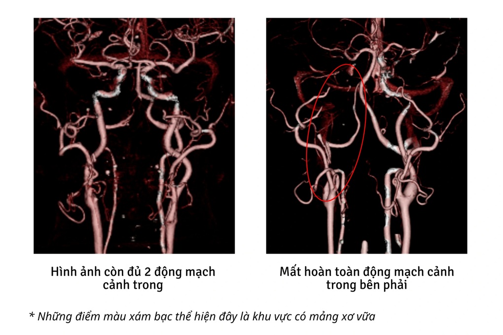 Dân công sở tổn thương não, suýt đột quỵ vì “nghiện việc”