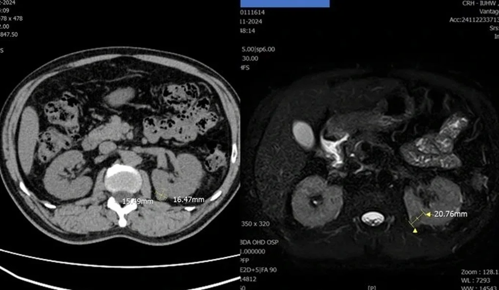 Nhiều người bất ngờ phát hiện ung thư thận dù không thấy gì bất thường - 1