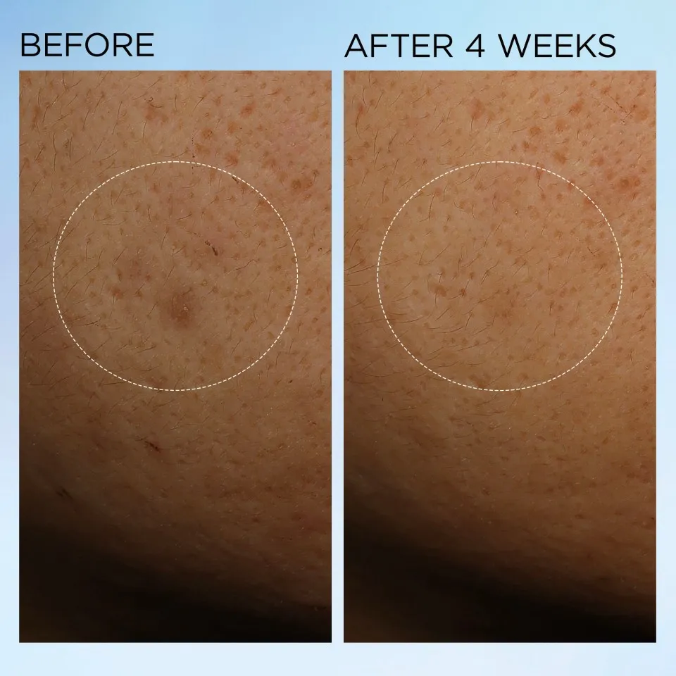 Before and after photos showing skin improvement after four weeks.