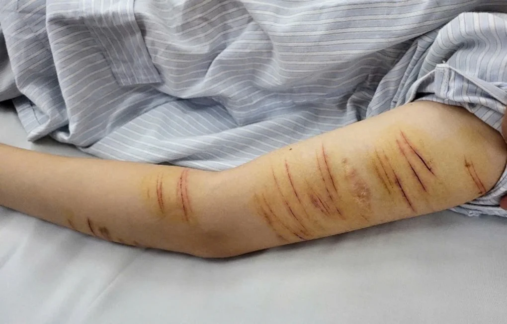 Nữ sinh luôn mặc áo dài tay kín mít, cha mẹ bàng hoàng phát hiện sự thật - 1