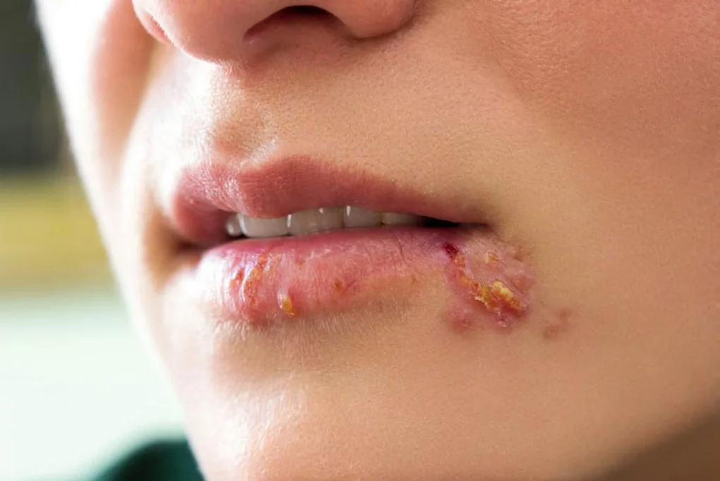 Những loại virus lây qua đường tình dục nguy hiểm bậc nhất - 2