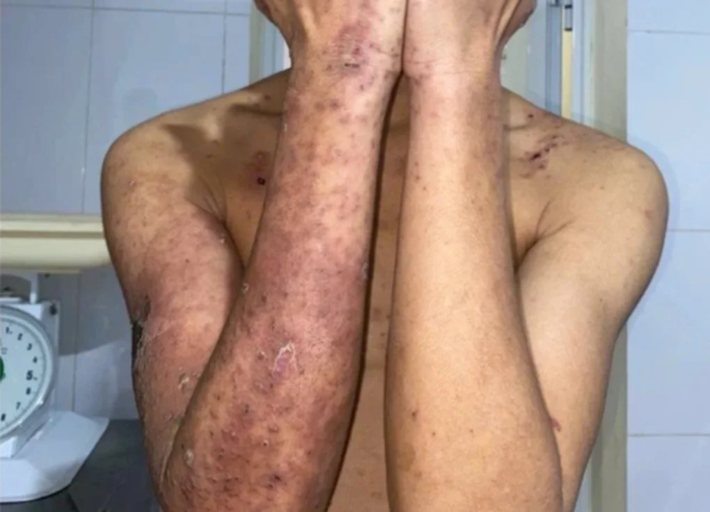 Đắp dịch kiến ba khoang... chữa ngứa, nam thanh niên loét toàn thân - 1