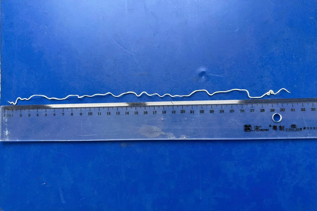 Nhiều nam giới mắc bệnh giun rồng hiếm gặp vì ăn đồ sống - 1