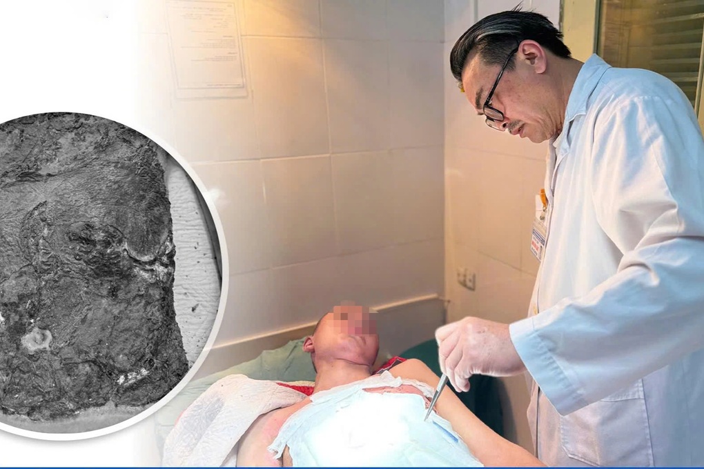 Bé trai 14 tuổi bị hoại tử nặng vì đắp thuốc nam chữa bỏng cồn