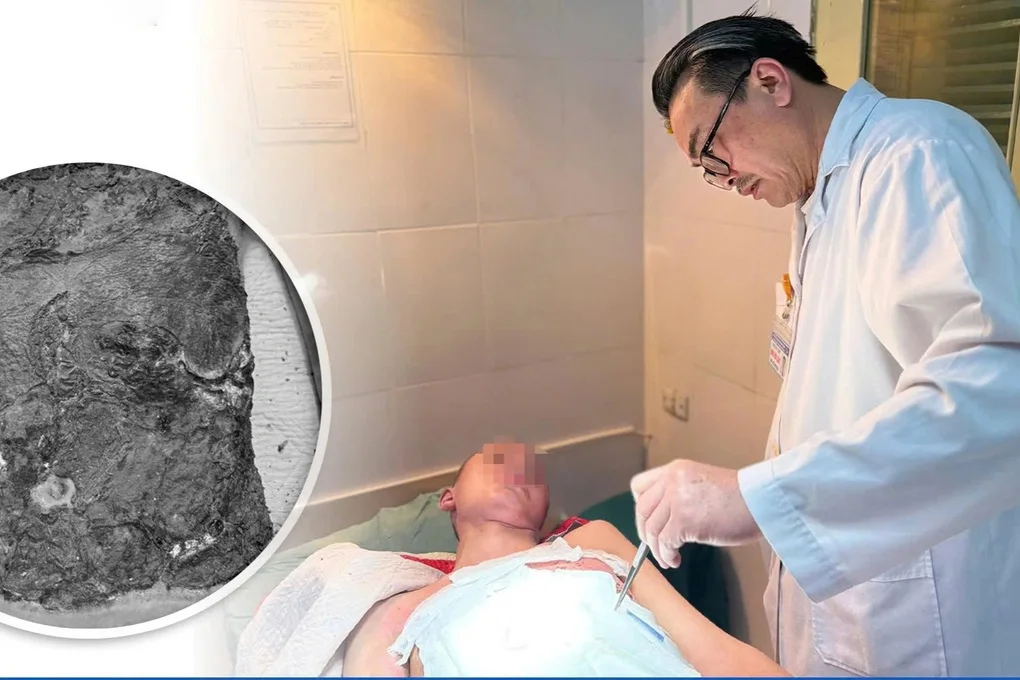 Bé trai 14 tuổi bị hoại tử nặng vì đắp thuốc nam chữa bỏng cồn - 1