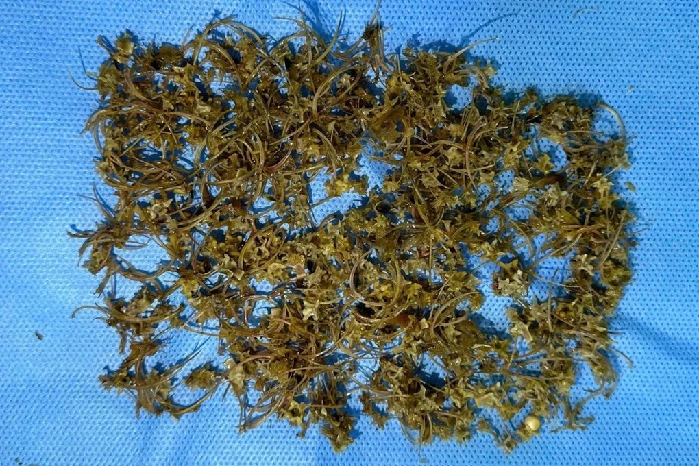 Người phụ nữ phải cấp cứu do nuốt hàng nghìn mảnh xương rắn - 2 Người phụ nữ phải cấp cứu do nuốt hàng nghìn mảnh xương rắn - 2