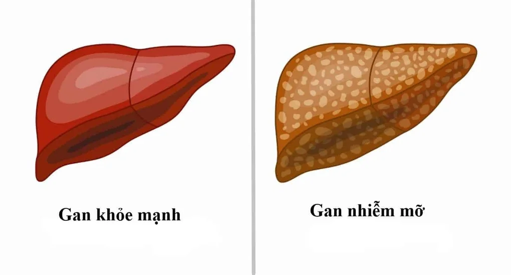 Gan nhiễm mỡ có dẫn đến ung thư gan? - 1