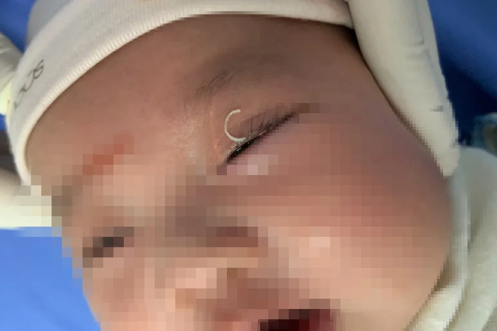 Mẹ cắt móng tay văng vào mắt, cháu bé 2 tháng tuổi lâm nguy - 1
