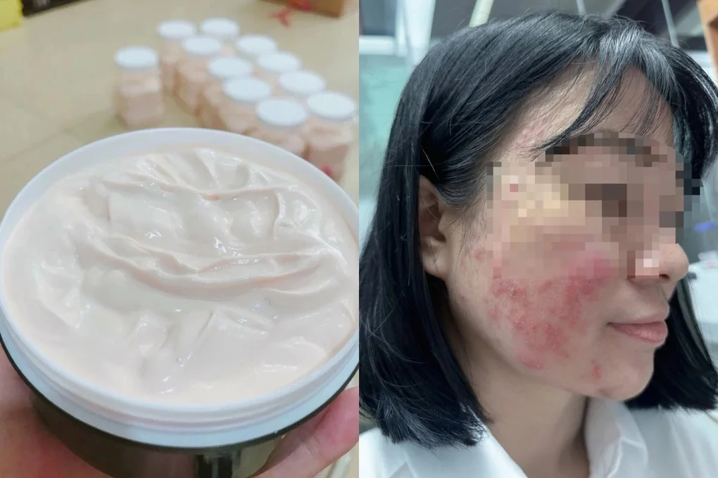 Mặt như trận địa, nguy cơ sẹo vĩnh viễn vì kem trị mụn mua qua mạng - 1