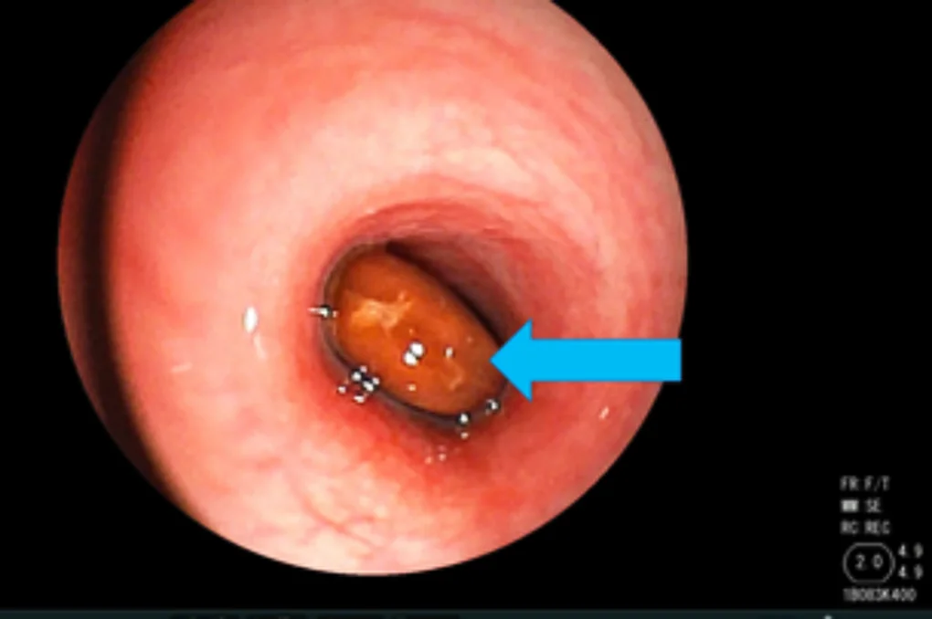TPHCM: Cấp cứu hai cháu bé gặp tai nạn nguy hiểm khi ăn - 1