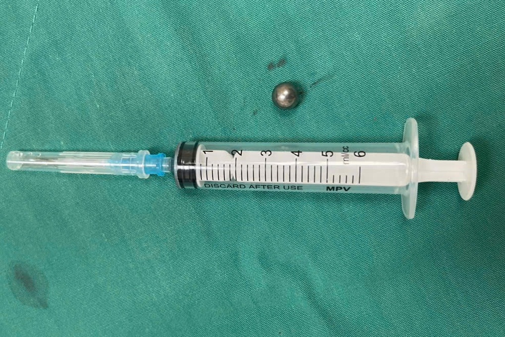 Bé trai 5 tuổi bị đạn từ súng đồ chơi bắn xuyên thủng mặt