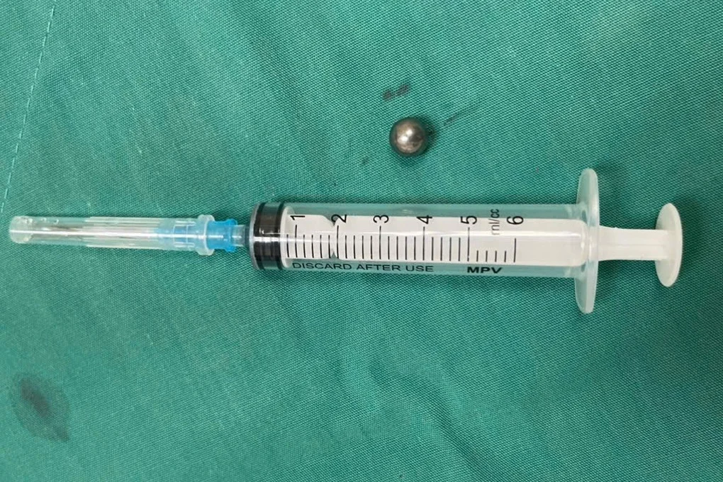 Bé trai 5 tuổi bị đạn từ súng đồ chơi bắn xuyên thủng mặt - 1