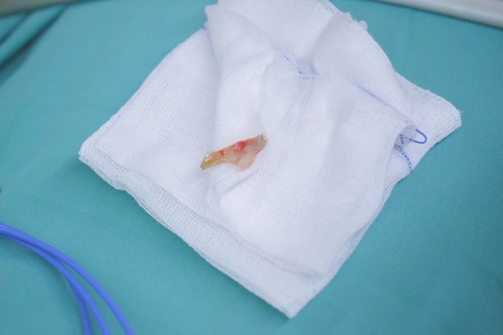 Người đàn ông nguy kịch sau khi ăn món quen thuộc trên mâm cơm người Việt - 2 Người đàn ông nguy kịch sau khi ăn món quen thuộc trên mâm cơm người Việt - 2