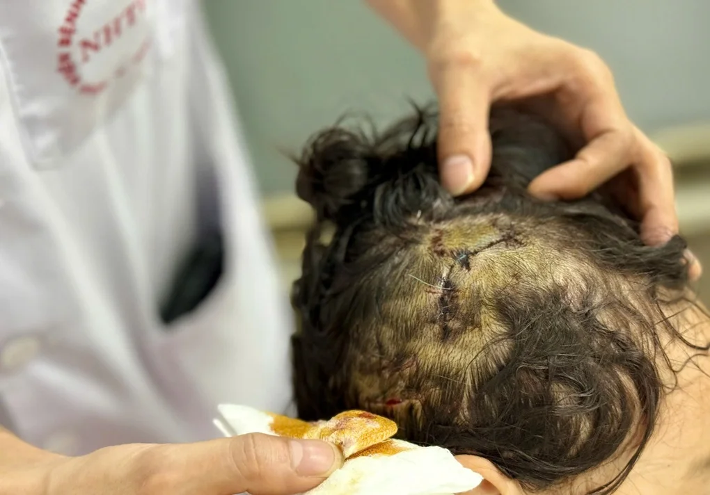 Hà Nội: Bé gái 5 tuổi bị chó nhà cắn liên tiếp vào đầu - mặt - 2