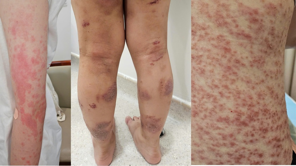 Mối nguy đe dọa tính mạng của bệnh miễn dịch, dị ứng