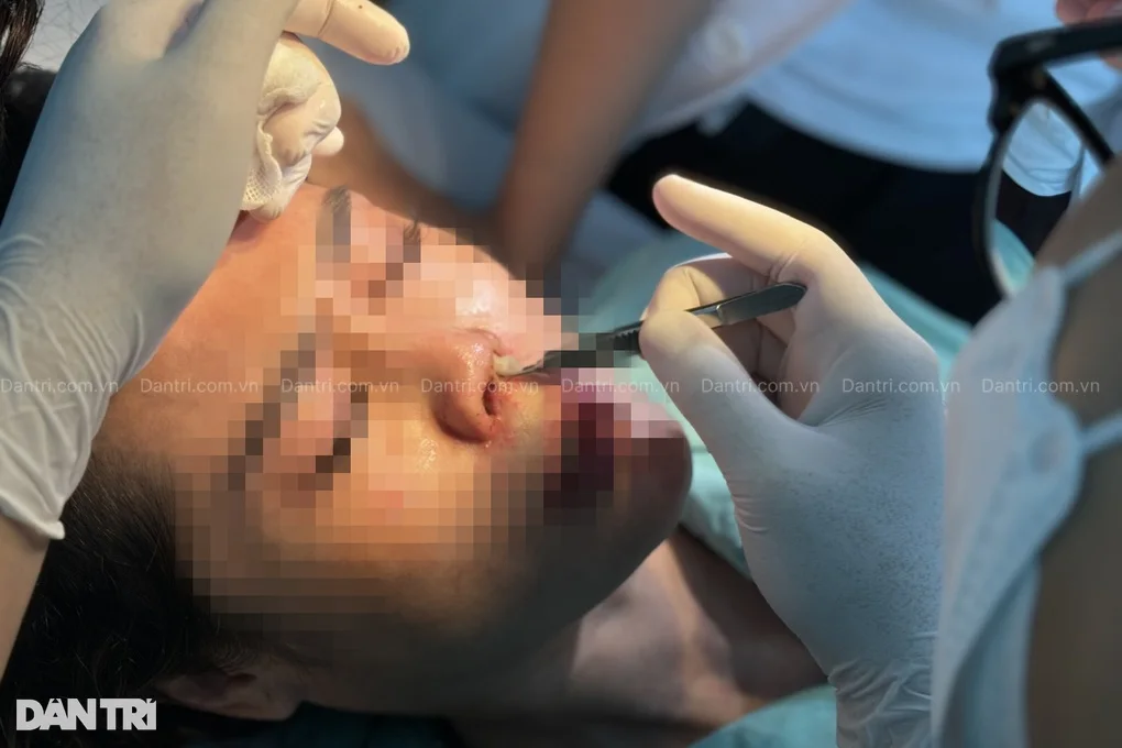 TPHCM: Mất 300 triệu đồng đổi lấy 6 lần sửa mũi đau đớn và bộ mặt biến dạng - 3