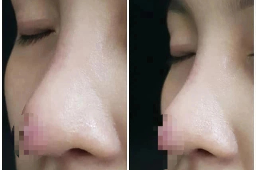 Chuyên gia thẩm mỹ: Người Việt không nên làm mũi “lai Tây, chuẩn Hàn”