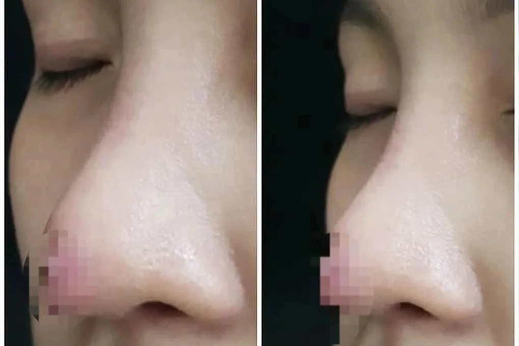 Chuyên gia thẩm mỹ: Người Việt không nên làm mũi lai Tây, chuẩn Hàn - 1