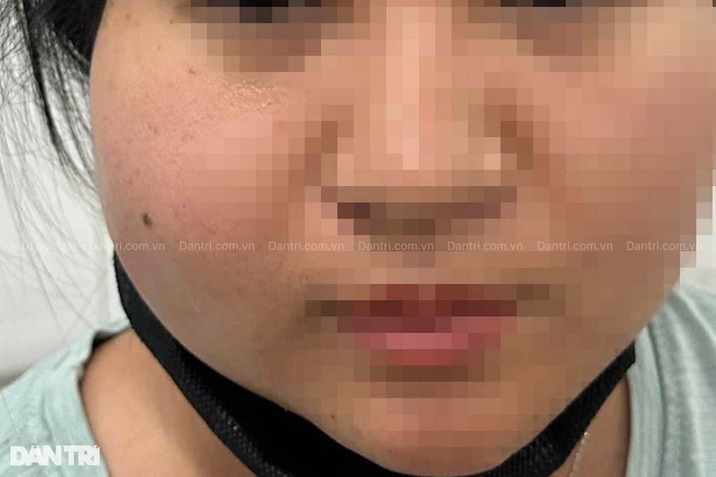 TPHCM: Cấp cứu 6 phụ nữ bị tai biến nặng nề vì tiêm filler
