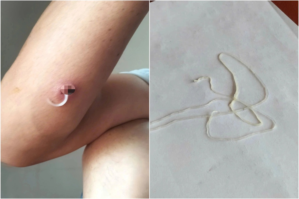 Cảnh báo: Nhiễm giun rồng nguy hiểm do ăn món “đặc sản” gỏi cá
