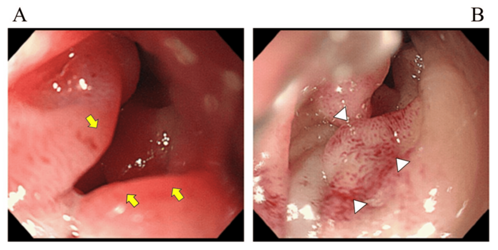 Duodenal Stenosis With Significant Edema Due to Complication From an Enteral Nutrition Tube: A Case Report