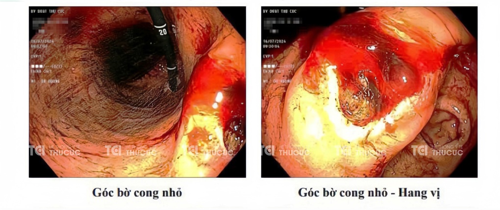 Loét dạ dày do HP kháng thuốc: Điều trị hiệu quả với phác đồ 4 thuốc
