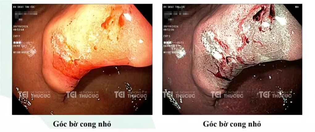 Loét dạ dày do HP kháng thuốc: Điều trị hiệu quả với phác đồ 4 thuốc - 2 Loét dạ dày do HP kháng thuốc: Điều trị hiệu quả với phác đồ 4 thuốc - 2
