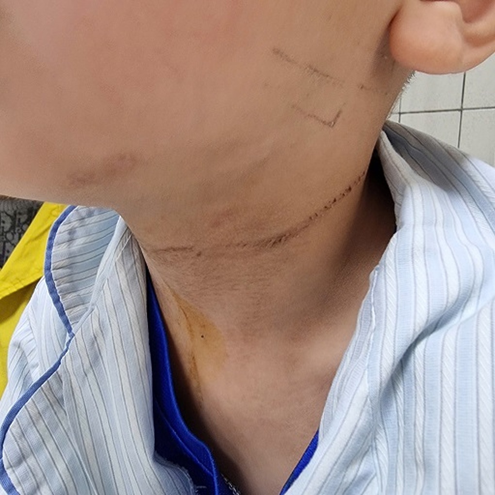 Bé 5 tuổi nghịch dây quần áo, bị dây thắt vào cổ
